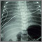 Totally anomalous pulmonary venous return - X-ray Totally anomalous pulmonary venous return - X-ray