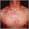 Acne - cystic on the chest Acne - cystic on the chest