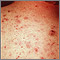 Acne - vulgaris on the back Acne - vulgaris on the back