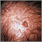 Actinic keratosis on the scalp Actinic keratosis on the scalp