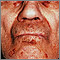 Amyloidosis of the face Amyloidosis of the face