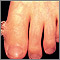 Wart (verruca) with a cutaneous horn on the toe Wart (verruca) with a cutaneous horn on the toe