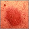 Dermatitis - pustular contact Dermatitis - pustular contact