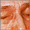 Dermatomyositis - heliotrope eyelids Dermatomyositis - heliotrope eyelids