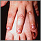 Epidermolysis bullosa, dominant dystrophic Epidermolysis bullosa, dominant dystrophic