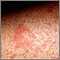 Eczema, atopic - close-up Eczema, atopic - close-up