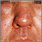 Edema - central on the face Edema - central on the face