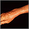Lentigo - solar with erythema on the arm Lentigo - solar with erythema on the arm