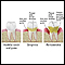 Periodontitis Periodontitis