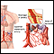 Mesenteric artery ischemia and infarction Mesenteric artery ischemia and infarction