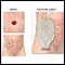 Ileostomy - stoma and pouch Ileostomy - stoma and pouch