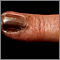 Skin cancer, melanoma on the fingernail Skin cancer, melanoma on the fingernail