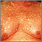 Pityriasis rubra pilaris on the chest Pityriasis rubra pilaris on the chest