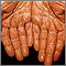 Pityriasis rubra pilaris on the palms Pityriasis rubra pilaris on the palms