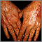 Skin cancer - squamous cell on the hands Skin cancer - squamous cell on the hands