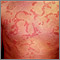 Hives (urticaria) on the chest Hives (urticaria) on the chest