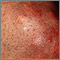 Xanthoma on the knee Xanthoma on the knee