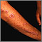 Lichen planus on the arm Lichen planus on the arm