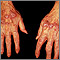 Lichen planus on the hands Lichen planus on the hands