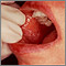 Lichen planus on the oral mucosa Lichen planus on the oral mucosa