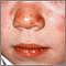 Lupus - discoid on a child's face Lupus - discoid on a child's face