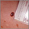 Skin cancer - close-up of level III melanoma Skin cancer - close-up of level III melanoma