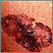 Skin cancer - melanoma superficial spreading Skin cancer - melanoma superficial spreading