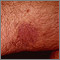 Kaposi sarcoma on the thigh Kaposi sarcoma on the thigh