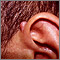 Keloid above the ear Keloid above the ear