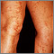 Livedo reticularis on the legs Livedo reticularis on the legs