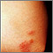 Sarcoidosis on the elbow Sarcoidosis on the elbow