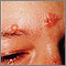 Sarcoidosis on the nose and forehead Sarcoidosis on the nose and forehead