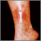 Dermatitis - stasis on the leg Dermatitis - stasis on the leg
