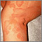 Ringworm - tinea corporis on the leg Ringworm - tinea corporis on the leg