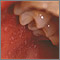 Measles, Koplik spots - close-up Measles, Koplik spots - close-up