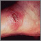 Leishmania panamensis on the foot Leishmania panamensis on the foot