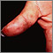 Dermatitis herpetiformis on the thumb Dermatitis herpetiformis on the thumb