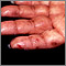 Dermatitis herpetiformis on the hand Dermatitis herpetiformis on the hand