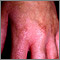 Photocontact dermatitis on the hand Photocontact dermatitis on the hand