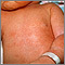Miliaria crystallina - chest and arm Miliaria crystallina - chest and arm