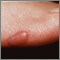 Keloid - on the foot Keloid - on the foot