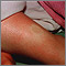 Pitting edema on the leg Pitting edema on the leg