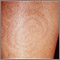 Post-inflammatory hyperpigmentation - calf Post-inflammatory hyperpigmentation - calf