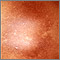 Post-inflammatory hyperpigmentation 2 Post-inflammatory hyperpigmentation 2