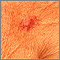 Basal Cell Carcinoma - close-up Basal Cell Carcinoma - close-up