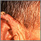 Actinic keratosis - ear Actinic keratosis - ear