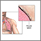 Chest tube insertion - series - Pleural cavity Chest tube insertion - series - Pleural cavity
