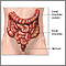 Colostomy - Series Colostomy - Series