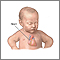 Patent ductus arteriosis (PDA) - series - Infant heart anatomy Patent ductus arteriosis (PDA) - series - Infant heart anatomy
