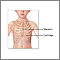 Pectus excavatum repair - series Pectus excavatum repair - series